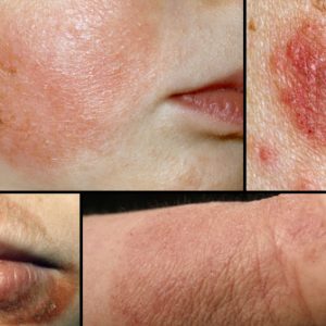 eczema skin rash