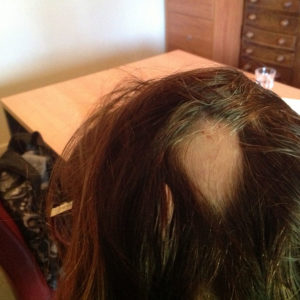 alopecia areata in women melbourne