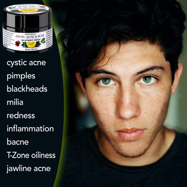 teen boy cystic acne cream