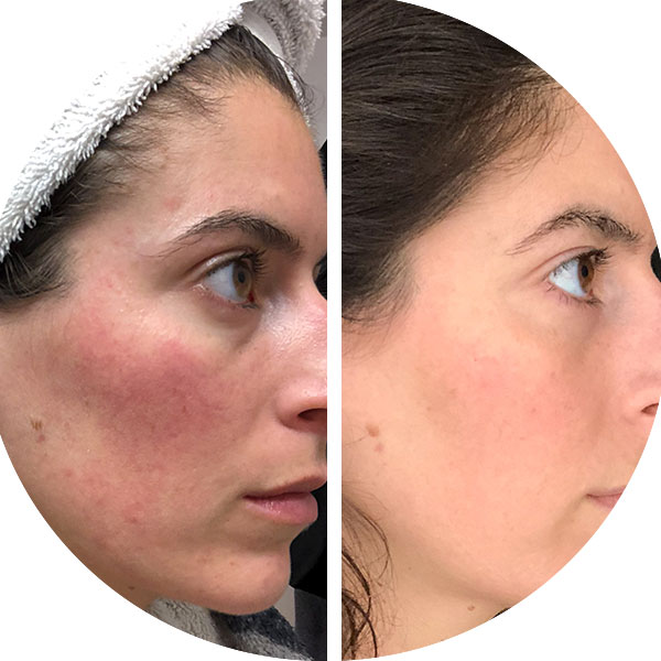 rosacea before after