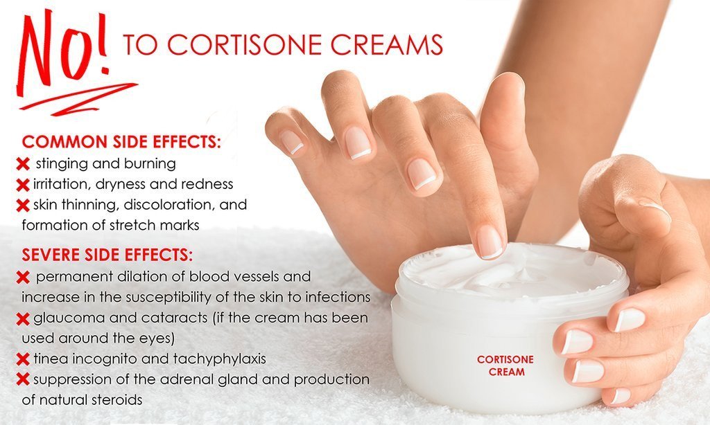 can you use steroid cream on eczema