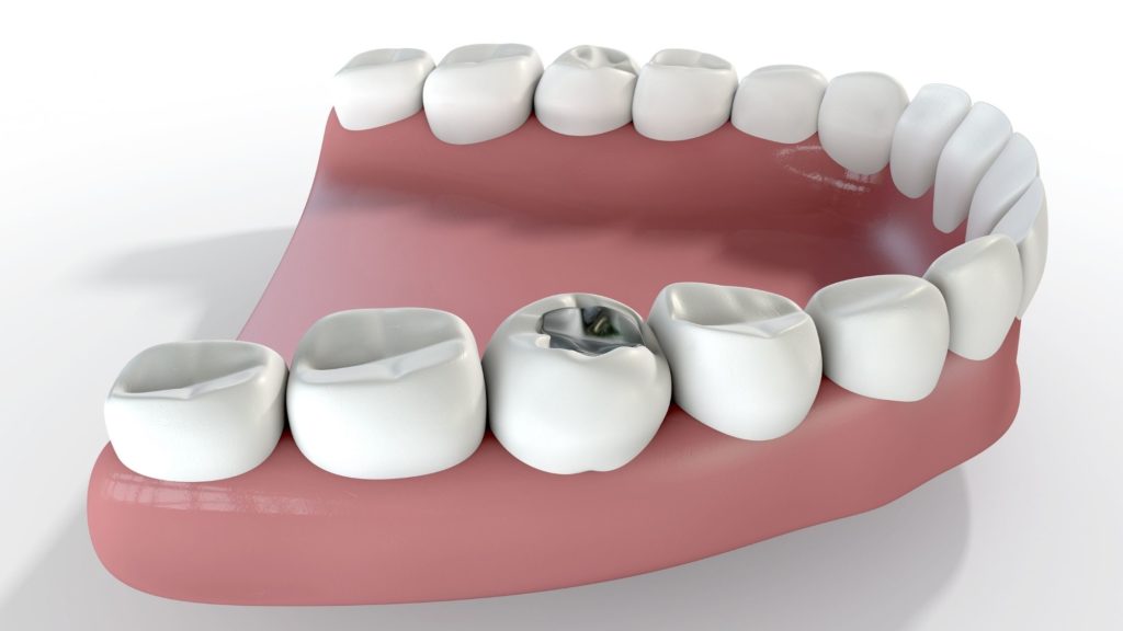 The problem with large metal (amalgam) fillings — Nova Smiles