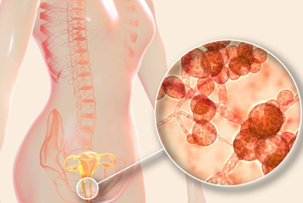 Candida, thrush, yeast infection, jock itch, tinea
