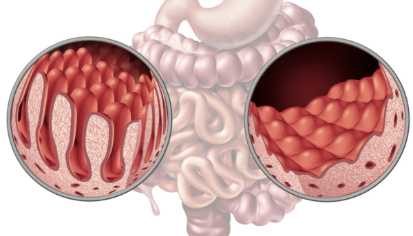 Coeliac Profile (Blood Test) - Image 3