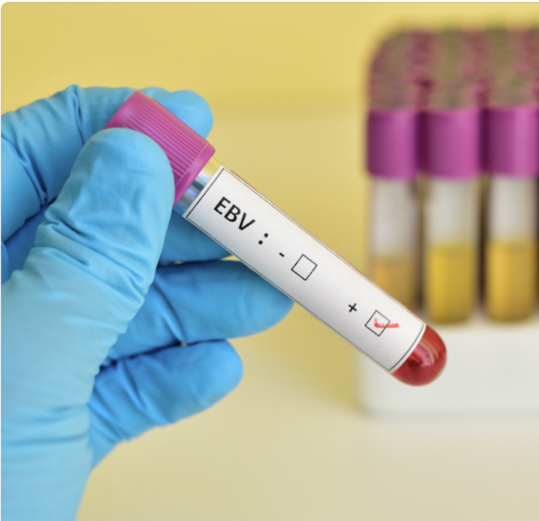 Chronic Ebv Blood Test Results