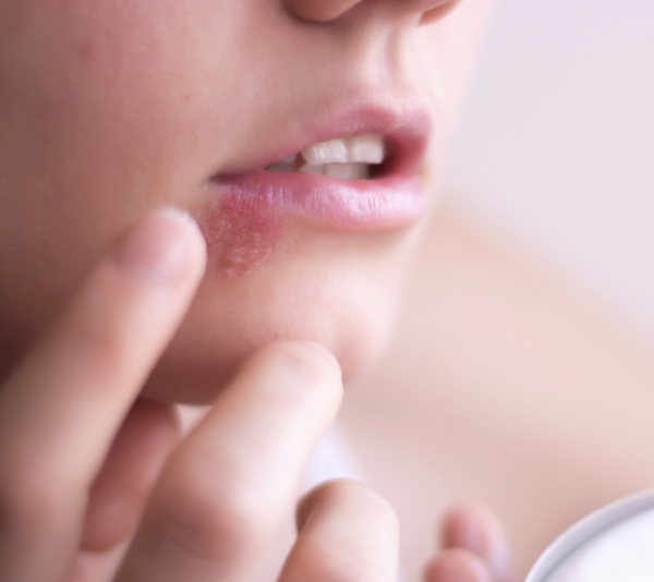 Herpes Simplex Virus I & 2 (HSV) - Image 3