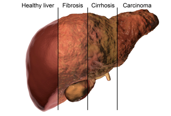 Liver Function Test - (blood)