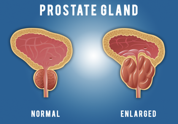 PSA - Prostate Blood Test