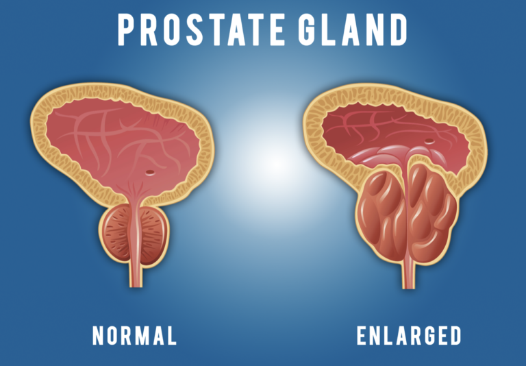 Psa Blood Test Enlarged Prostate