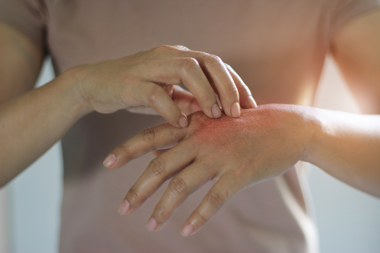 eczema hand