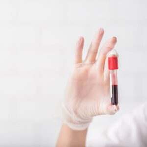Epstein-Barr Virus (EBV) Blood Test