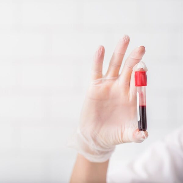 Epstein-Barr Virus (EBV) Blood Test