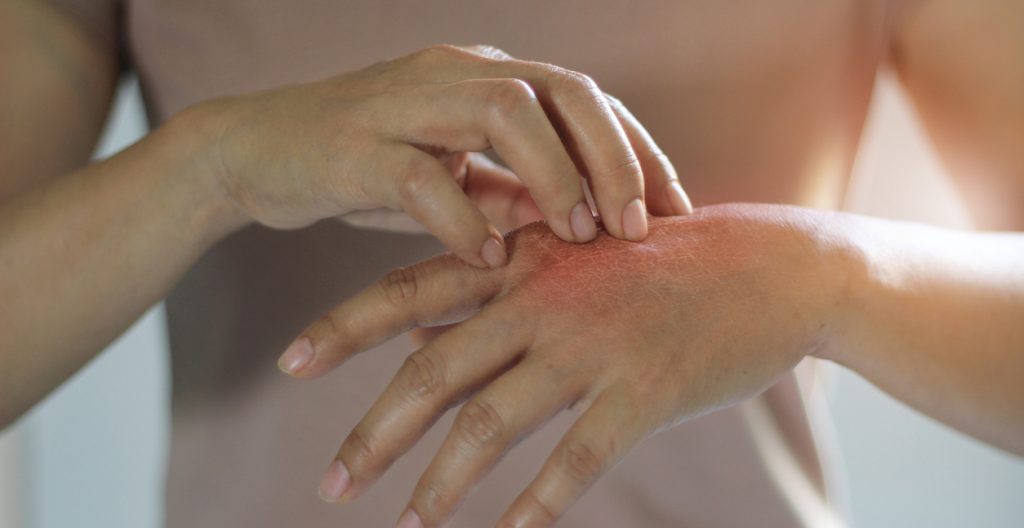 eczema hand
